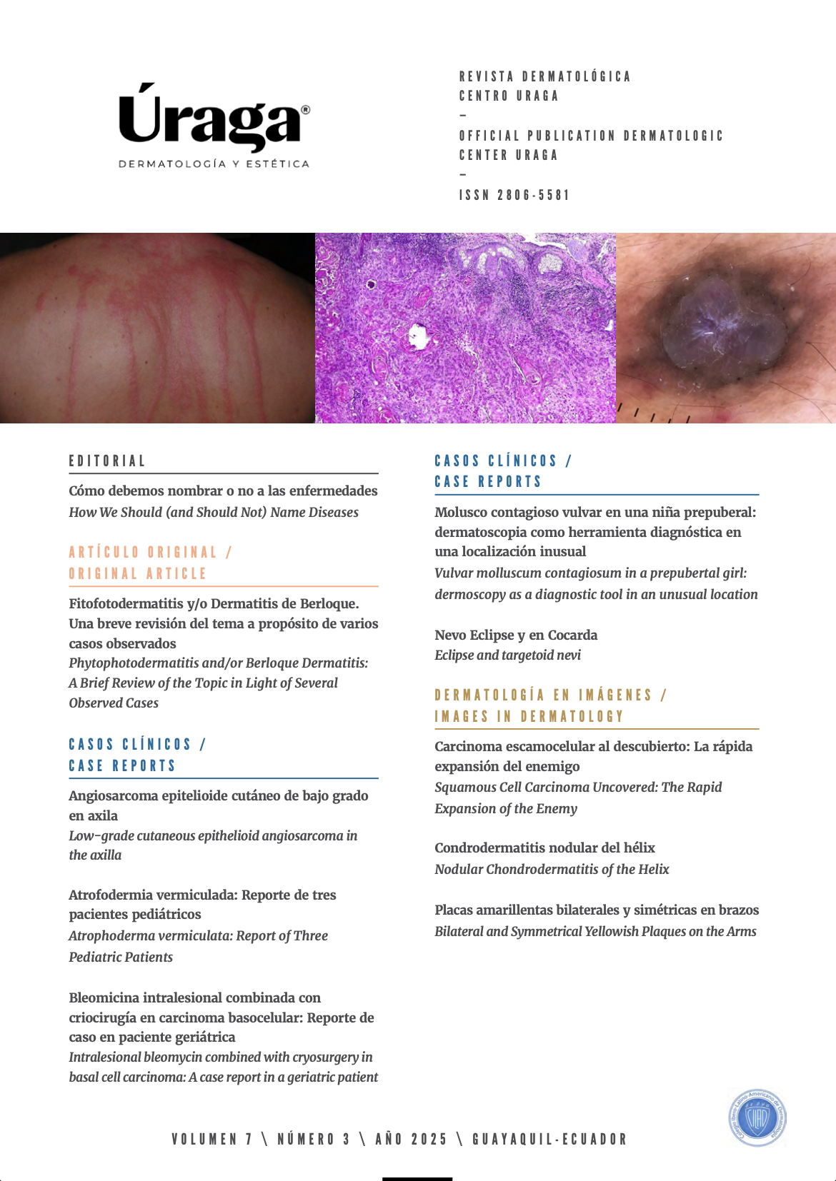 					Ver Vol. 7 Núm. 3 (2025): Revista Dermatológica Centro Úraga
				