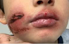 Figura 2. Lesiones antes señaladas tomando piel de la cara y mucosa labial.